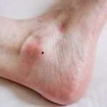 Tick Embedded in Skin? Here are 6 speedy Steps To Get It Out Quickly! Tick embedded in skin